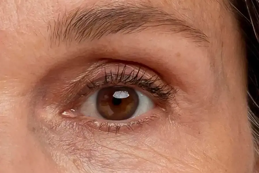 Augenpartie vor der Anwendung der orangeblue Anti-Aging Augencreme – Krähenfüße und Augenringe sichtbar